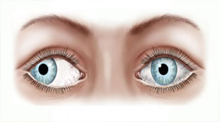 انحراف چشم چیست و چگونه درمان می شود